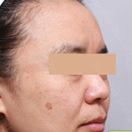 기미색소 시술 전 이미지