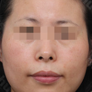 기미색소 시술 전 이미지